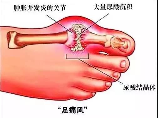 音樂療法如何預防尿酸高